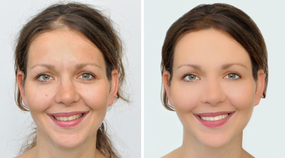 How Much Does A Hair System Costs? Addcolo